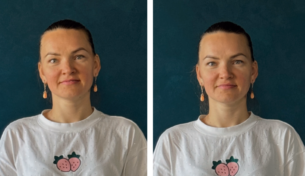 Корекція симетрії обличчя та зняття напруги