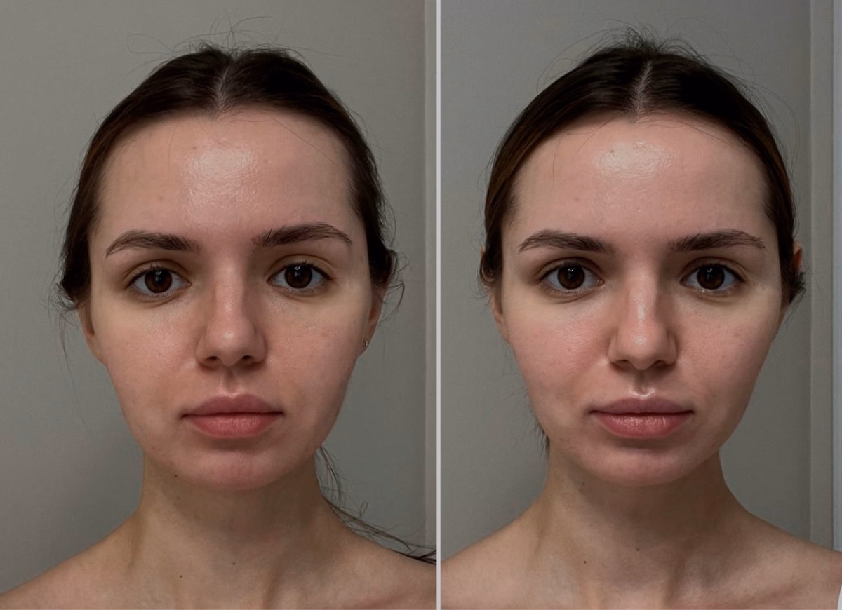 Відновлення симетрії обличчя