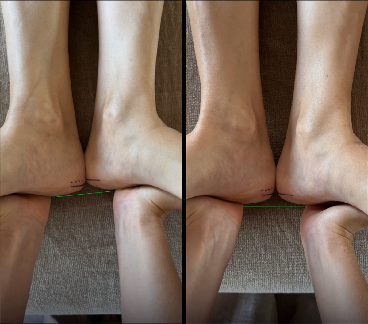 Корекція різниці довжини ніг та стабілізація тазу (детально)