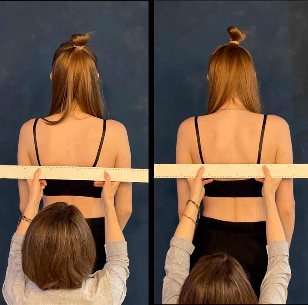 Корекція лінії плечей та лопаток